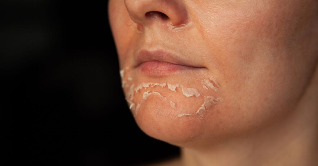 Peel da làm bong tế bào da cũ và thay thế bằng tế bào da mới