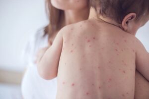 Sốt phát ban ở trẻ em có nhiều triệu chứng nhận biết bệnh khác nhau