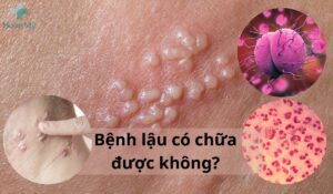 Bệnh lậu có chữa được không?