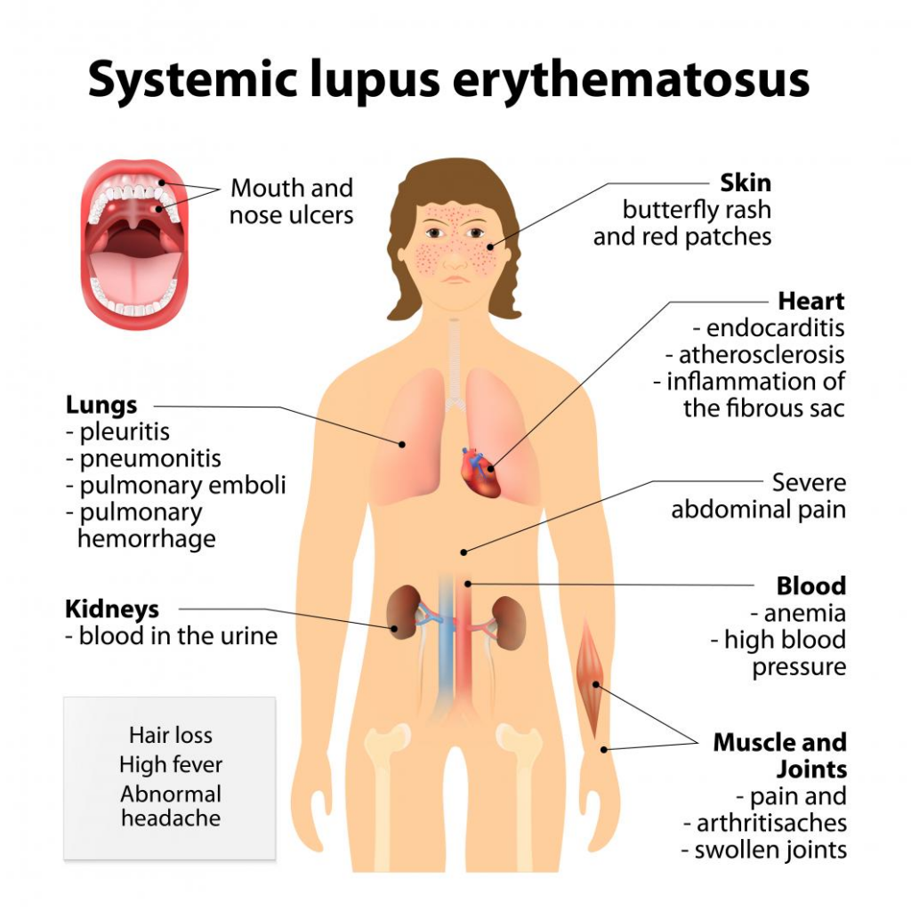 Biến chứng của Lupus ban đỏ lên phổi, tim, dây thần kinh, máu