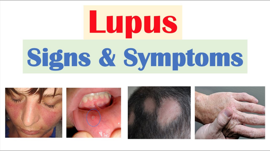 Biểu hiện và triệu chứng của Lupus ban đỏ