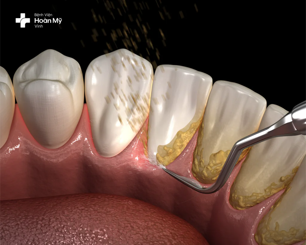 Loại bỏ cao răng giúp cải thiện sức khoẻ răng miệng đáng kể