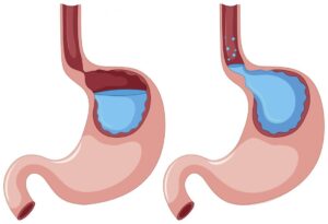 Dạ dày khi bị trào ngược