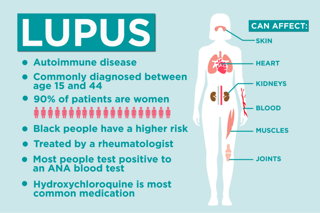 Lupus ban đỏ hệ thống là bênh lý tự miễn thường gặp