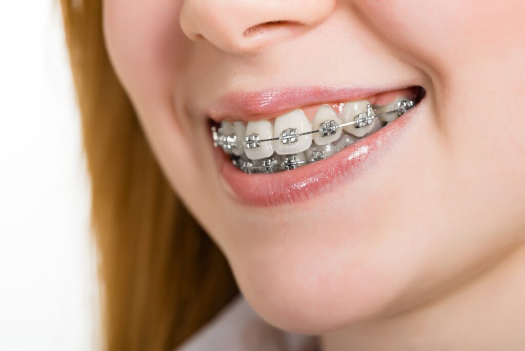 Niềng răng là giải pháp khắc phục các nhược điểm về răng