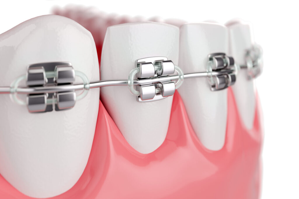 Niềng răng mắc cài tự động giúp việc thay dây cung dễ dàng