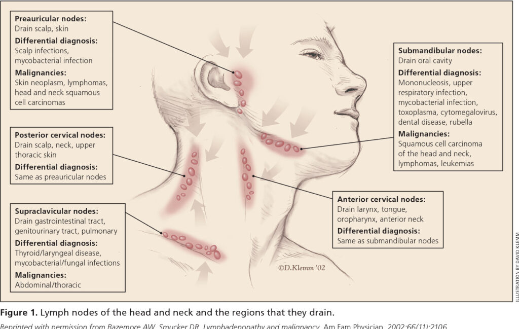 Bị nổi hạch là dấu hiệu dễ nhận thấy khi bị ung thư vòm họng