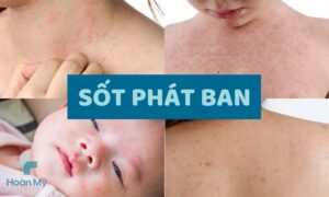 Sốt phất ban