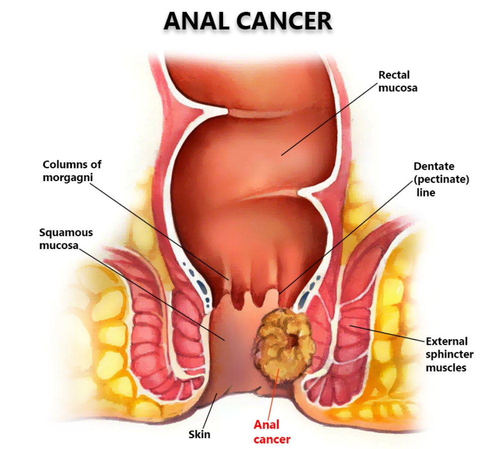 Ung thư hậu môn - Anal cancer