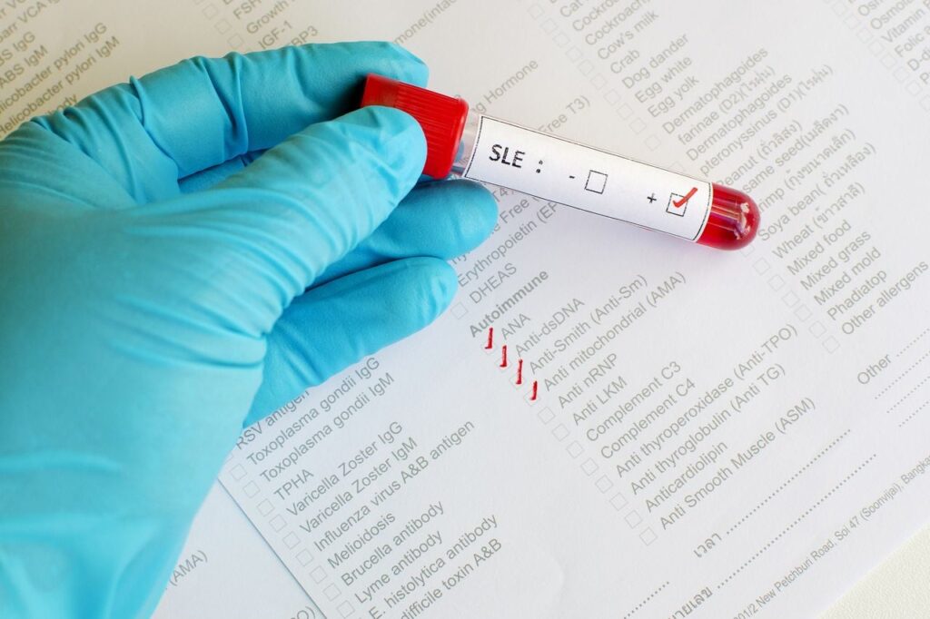 Xét nghiệm để phát hiện bệnh Lupus ban đỏ