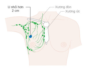 Đa số ung thư vú bắt đầu từ tế bào trong ống tuyến vú, gọi là ung thư vú dạng ống tuyến vú