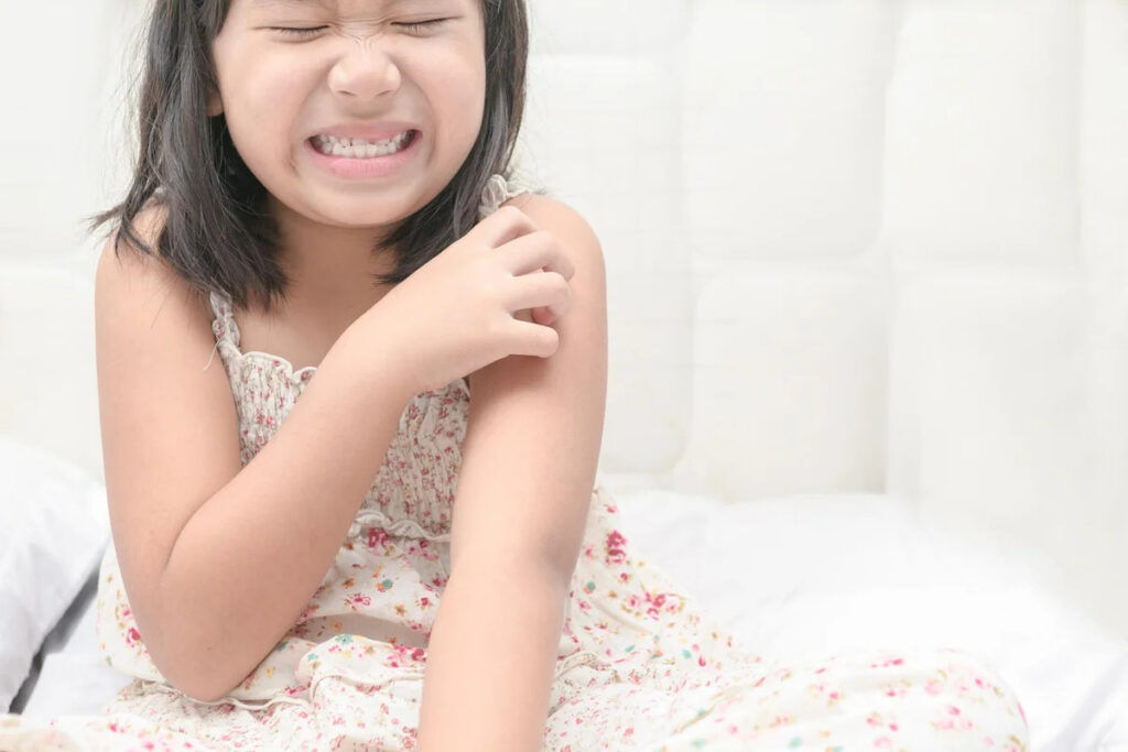 Dấu hiệu và triệu chứng viêm da cơ địa ở trẻ em