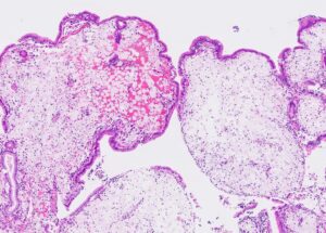 Các thể polyp cholesterol thường có kích thước nhỏ