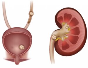 Cỏ mực có khả năng hỗ trợ điều trị sỏi thận