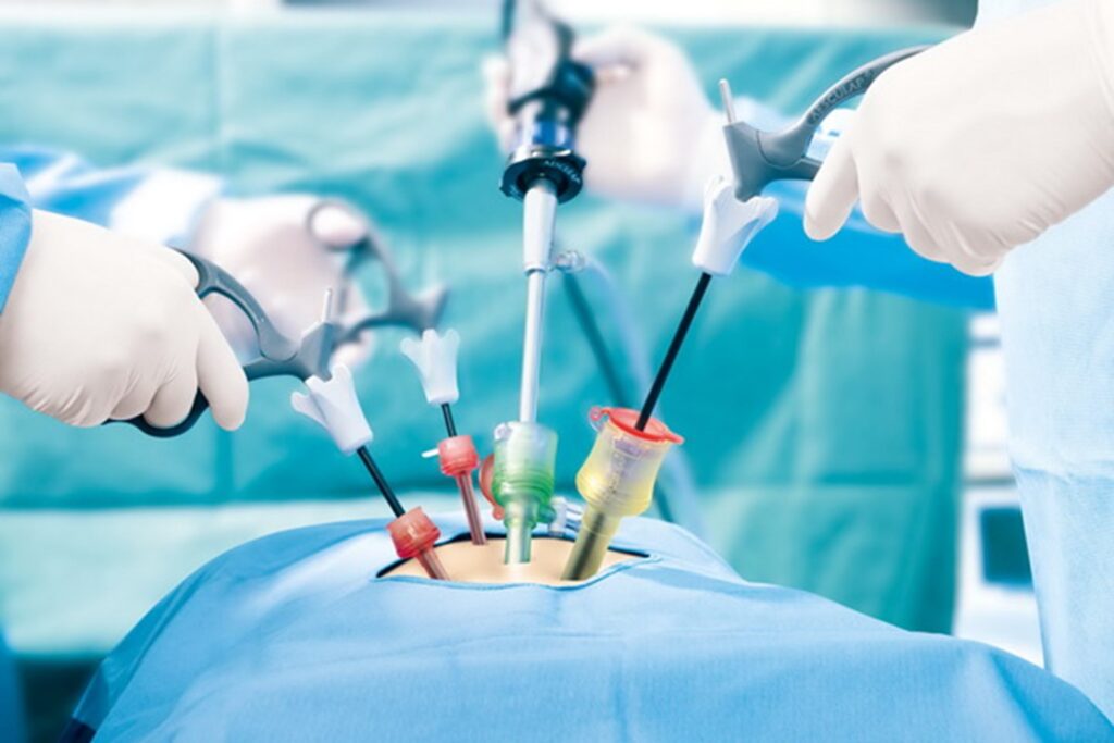 Phẫu thuật nội soi là phương pháp an toàn hiệu quả giúp cắt bỏ cơ quan và loại bỏ hoàn toàn polyp ác tính 
