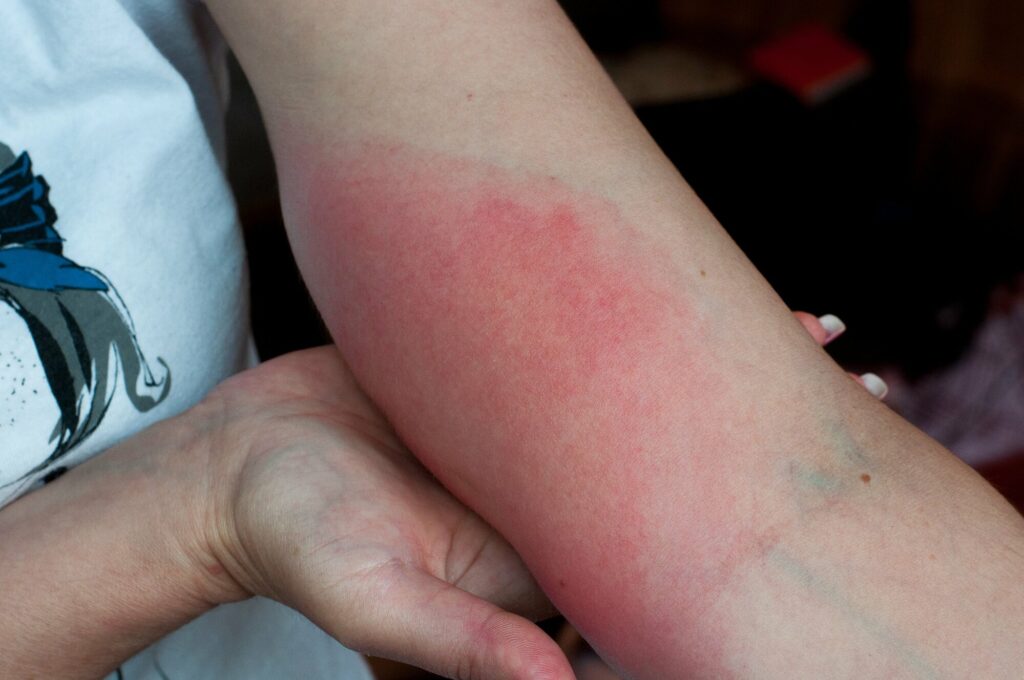 Mẩn đỏ trên da là biểu hiện thường thấy của phản ứng dị ứng 