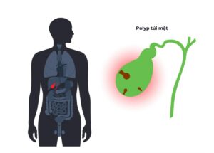 Các thể polyp ác tính có thể phát triển thành ung thư túi mật