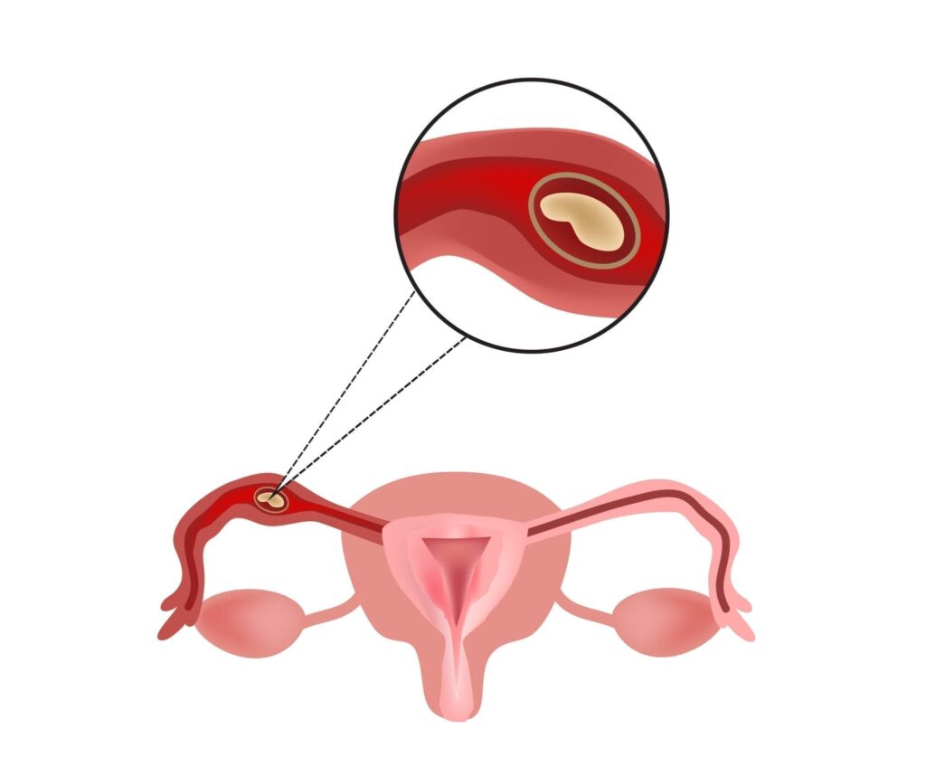 Vị trí thai đậu bên ngoài tử cung 