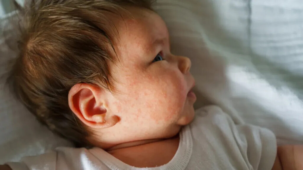 Dấu hiệu và triệu chứng viêm da cơ địa ở trẻ sơ sinh
