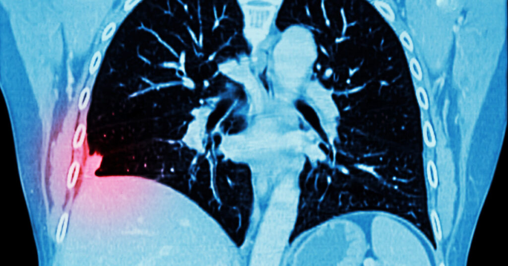 Chụp CT phổi có phát hiện ra bệnh ung thư không? 