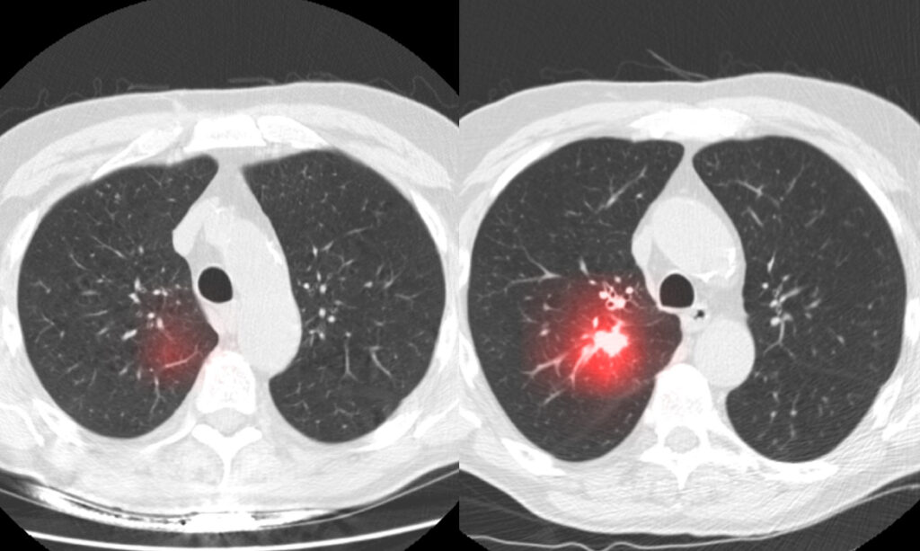 Chụp CT phổi là gì? 