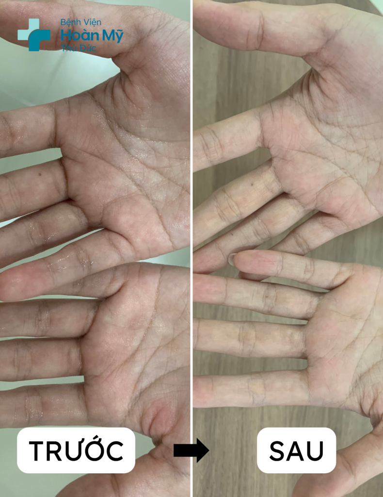Bàn tay trước và sau khi được điều trị nội soi cắt hạch giao cảm, cải thiện hoàn toàn triệu chứng tăng tiết mồ hôi