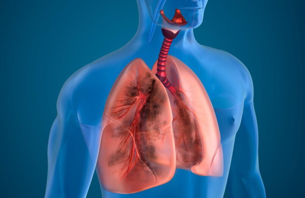 Đôi khi căn bệnh này là nguồn cơn cho căn bệnh phổi mãn tính vô cùng nguy hiểm 