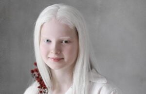 Albinism được phân loại nhờ cách thức di truyền