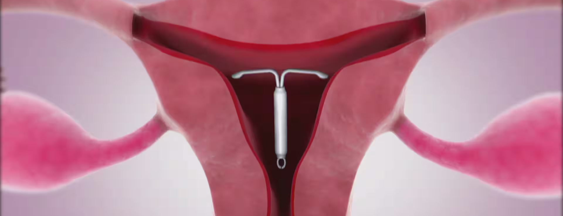 Nhiễm trùng cơ quan sinh dục cũng là biểu hiện cho thấy tuột vòng tránh thai 