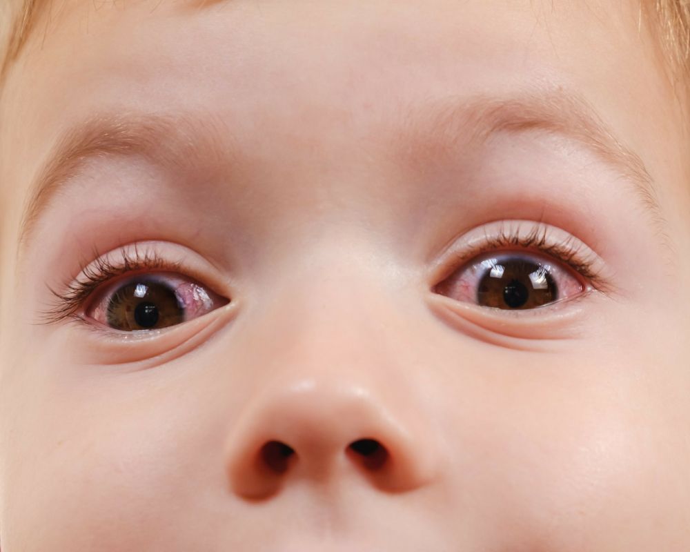 Dấu hiệu đau mắt đỏ ở trẻ sơ sinh