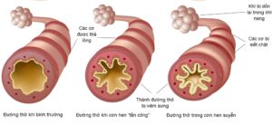 Hen suyễn là bệnh mãn tính liên quan đến hệ hô hấp