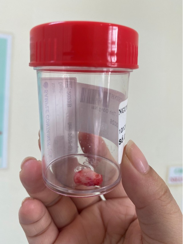 Chuyên khoa Tai mũi họng – Bệnh viện Hoàn Mỹ ITO Đồng Nai phẫu thuật thành công cho bệnh nhân có răng mọc lạc chỗ trong xoang sàng