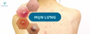 Mụn lưng: Nguyên nhân và cách điều trị đơn giản