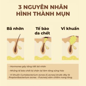 Nguyên nhân chính gây mụn đầu cồi đen