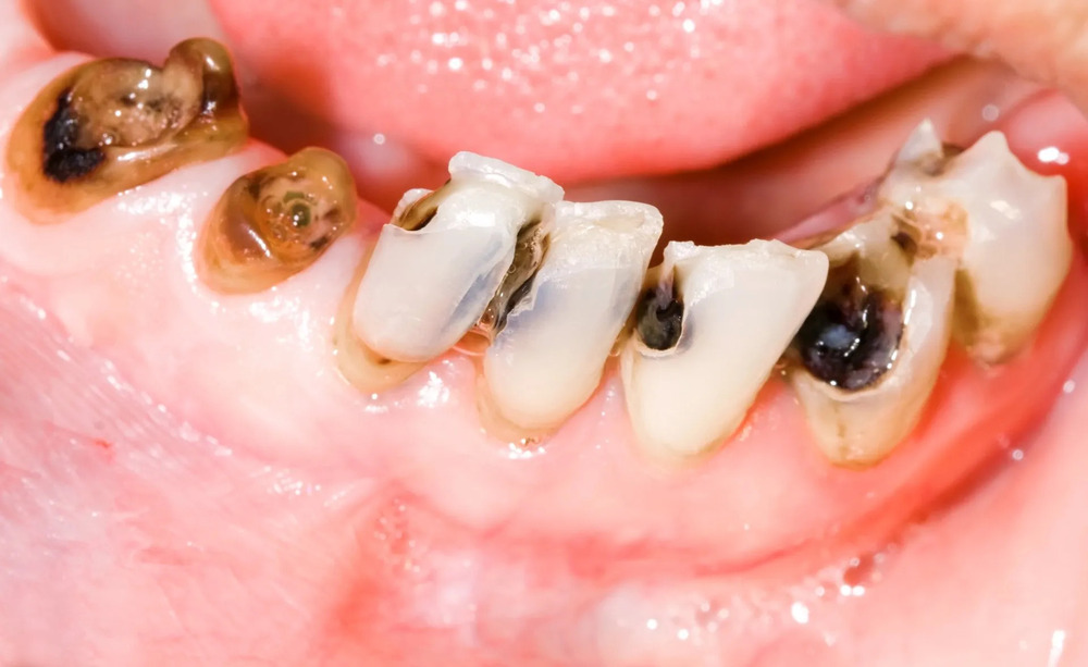 Sâu răng gây ra những lỗ sâu đen làm mất thẩm mỹ