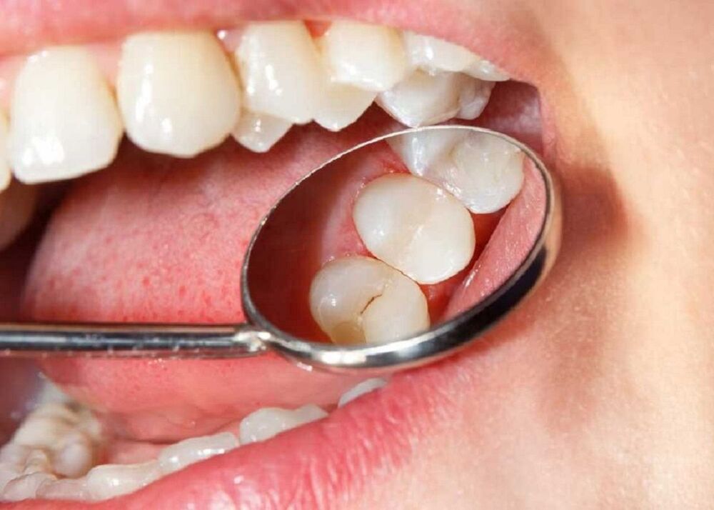 Đảnh răng không đúng cách là nguyên nhân sâu răng