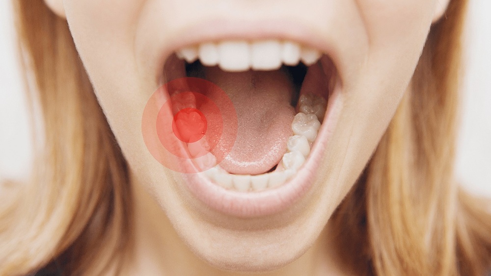 Răng đau nhức, hôi miệng là dấu hiệu nhận biết răng bị sâu