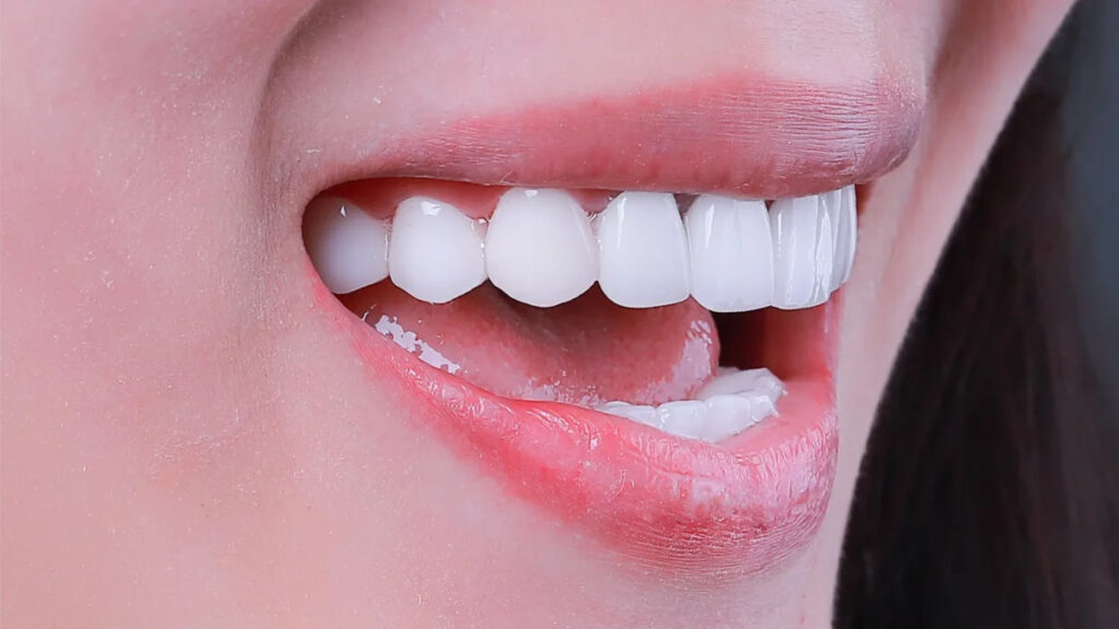 Tẩy trắng răng sẽ được kéo dài từ 6 tháng đến 1 năm 