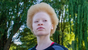 Bệnh albinism không ảnh hưởng đến tuổi thọ người bệnh