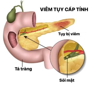 Viêm tuỵ cấp tính