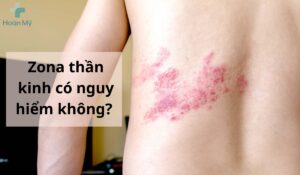 Zona thần kinh có nguy hiểm không?