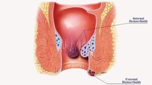 Bệnh trĩ là gì?