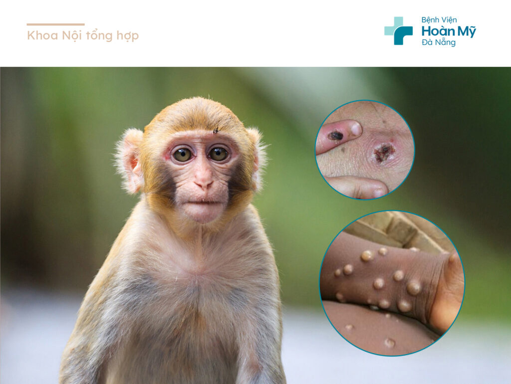 Bệnh đậu mùa khỉ: Nguyên nhân, triệu chứng và cách phòng ngừa
