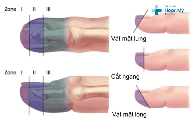 Phân độ vết thương ngón tay