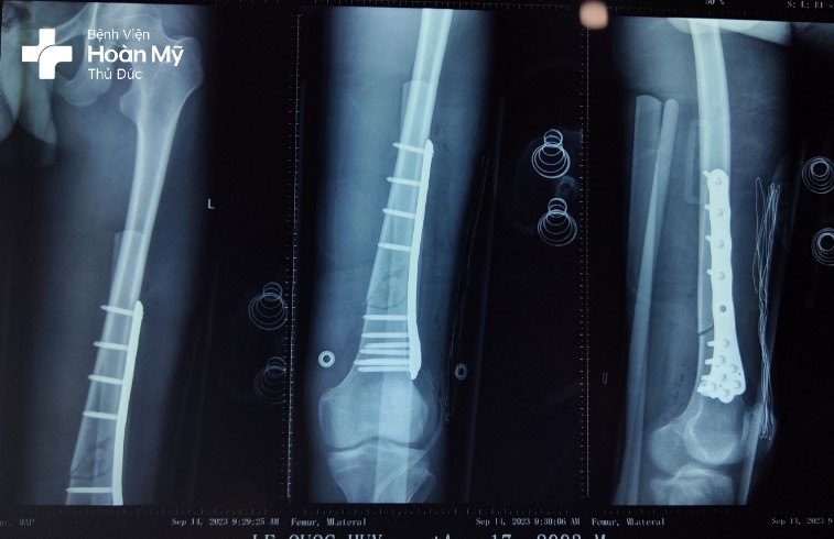 Hình chụp X-quang sau mổ: kết hợp xương nẹp vít