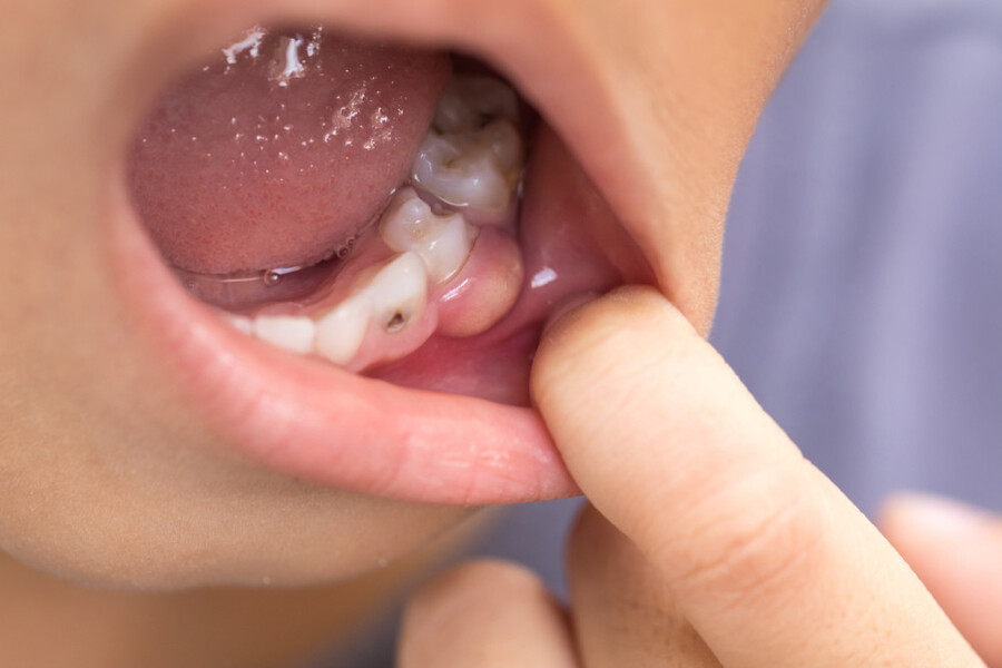 Áp xe răng là tình trạng xuất hiện túi mủ do nhiễm trùng từ vi khuẩn gây ra và thường xảy ra ở các khu vực gần răng vì nhiều lý do khác nhau.