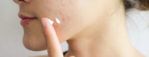 Azelaic acid là gì? Azelaic acid có tác dụng gì với da mặt?