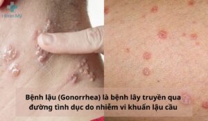 Vi khuẩn lậu cầu gây ra bệnh lậu ở cả nam và nữ