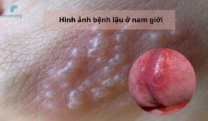 Hình ảnh bệnh lậu ở nam giới