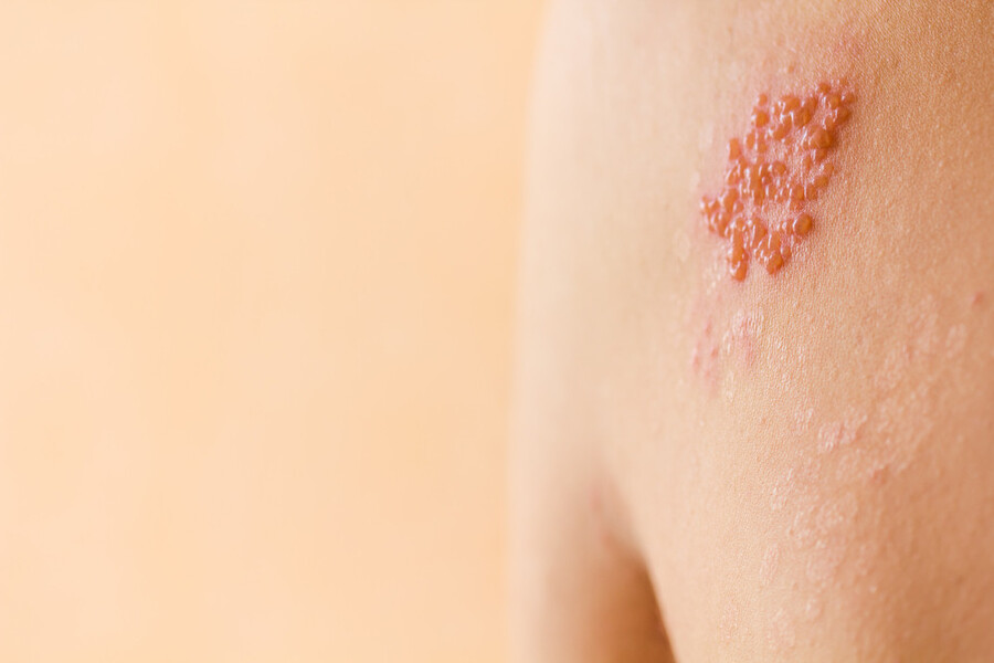 Bệnh zona là một bệnh nhiễm virus varicella-zoster gây phát ban trên da.